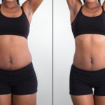 Non Surgical Liposuction In Chandigarh